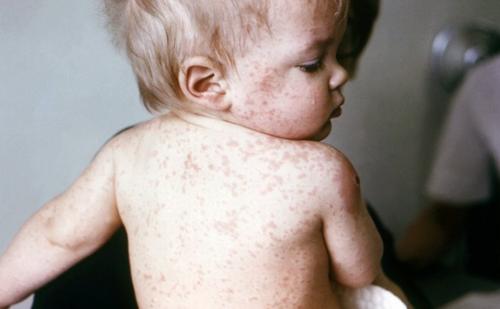 ХӨСҮТ  Улаанбурхан өвчний батлагдсан тохиолдол 13.648 болжээ