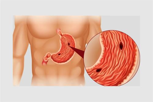 Ходоодны шархлааны эмчилгээний 85 хувийг ЭМД-ын сангаас хөнгөлнө