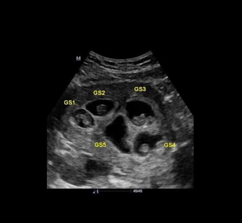 ЭЕРЭГ: Монголын анхны таван ихэр хүүхэд удахгүй мэндэлнэ