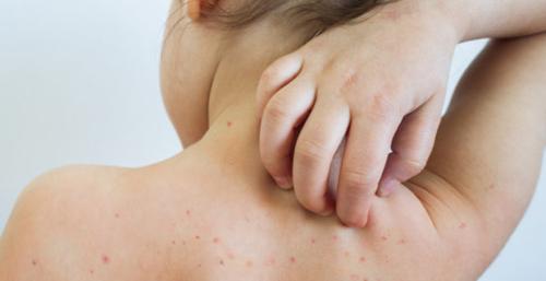 ХӨСҮТ: Улаанбурхан өвчний лабораториор батлагдсан тохиолдол 986 болжээ